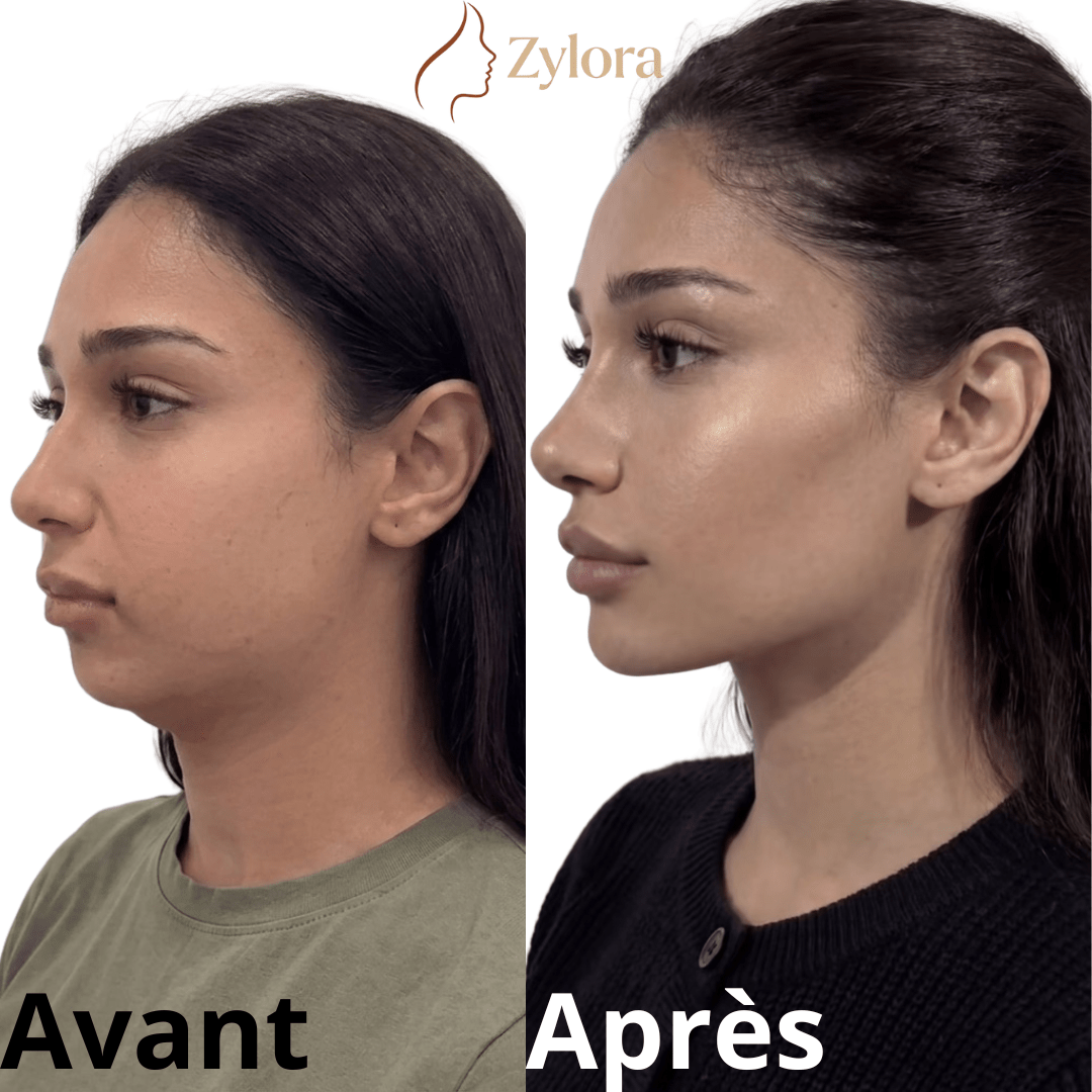 Brosse de Drainage Lymphatique Visage – Zylora - Zylora